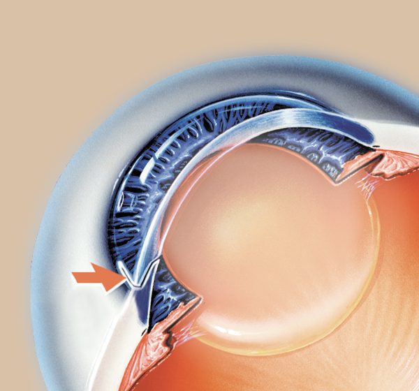 Cataract Surgery Step1