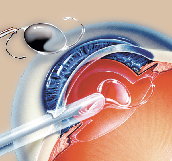Cataract Surgery Step3